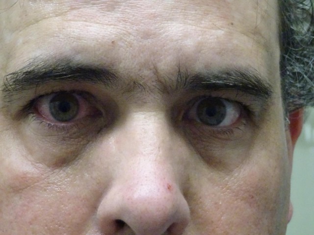 All day I've had a problem with sweat running into my right eye and stinging it. It's gone quite red...